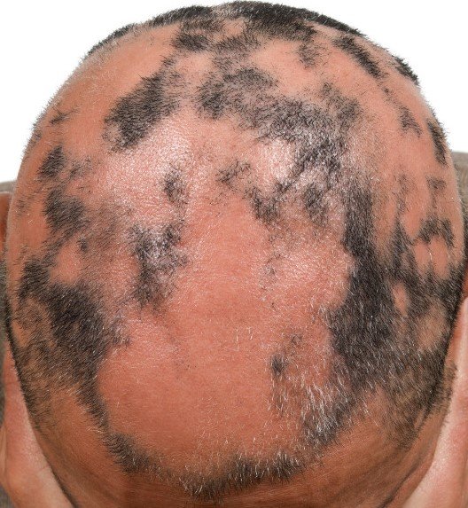Doenças do couro cabeludo