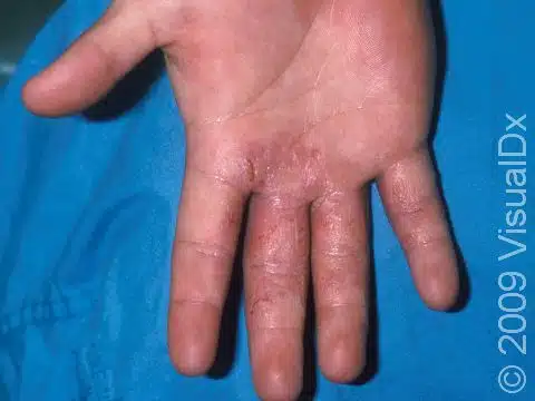 Dermatite de Contato Alérgica
